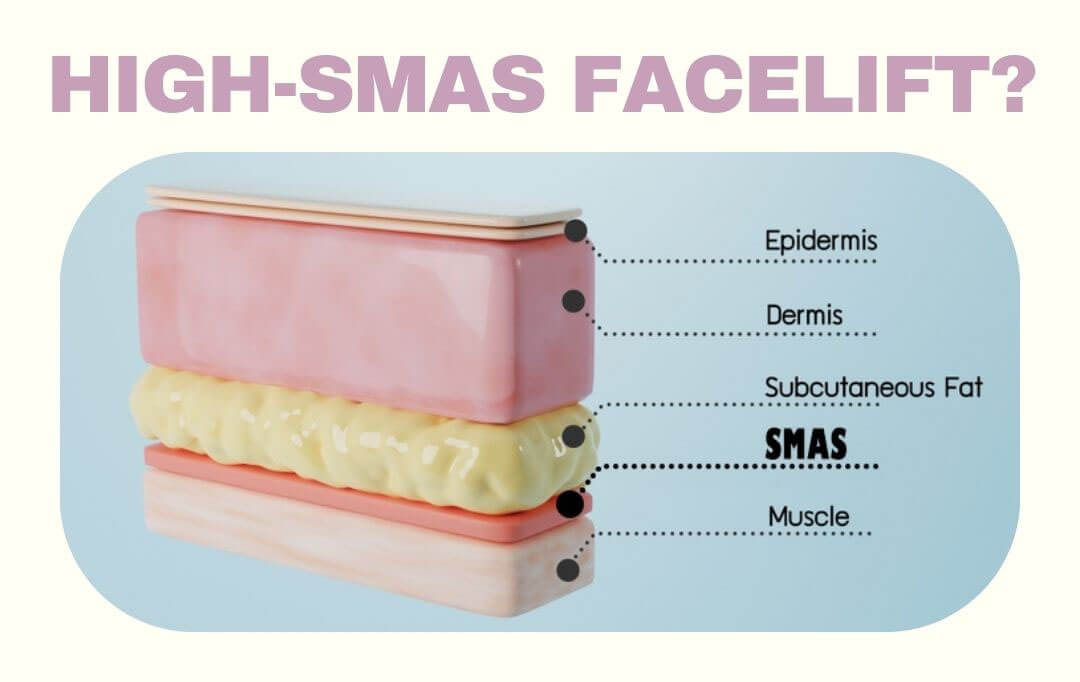 High-SMAS-Facelift