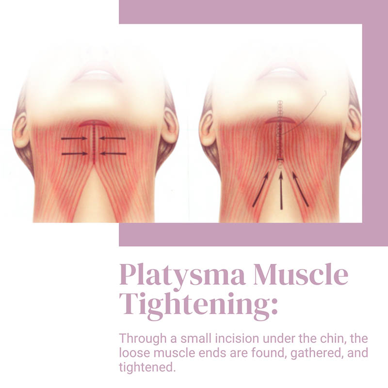 platysmaplasty