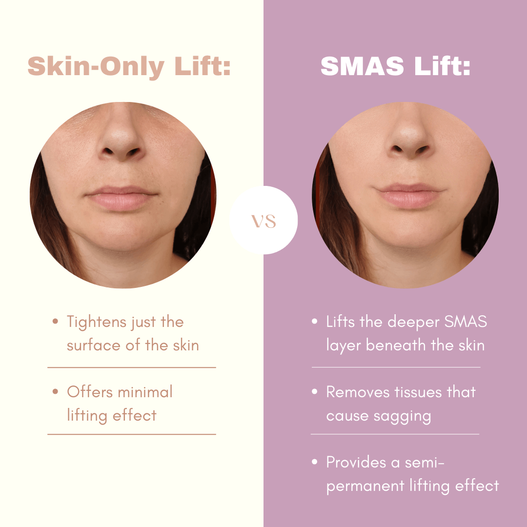 SMAS-lift