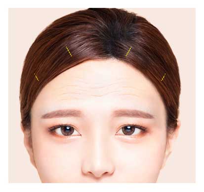 endoscopic forehead lift procedure