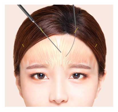 endoscopic forehead lift procedure 2