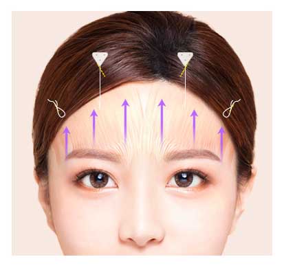 endoscopic forehead lift procedure 5