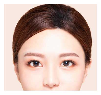 endoscopic forehead lift procedure 6