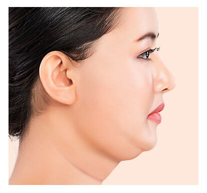 high-SMAS-facelift-procedure-1