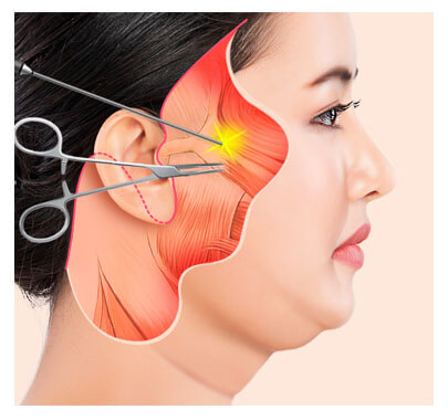 high-SMAS-facelift-procedure-3