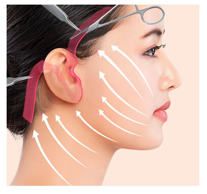 high-SMAS-facelift-procedure-4