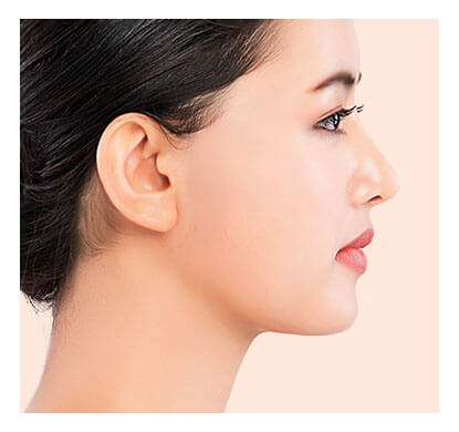 high-SMAS-facelift-procedure-6