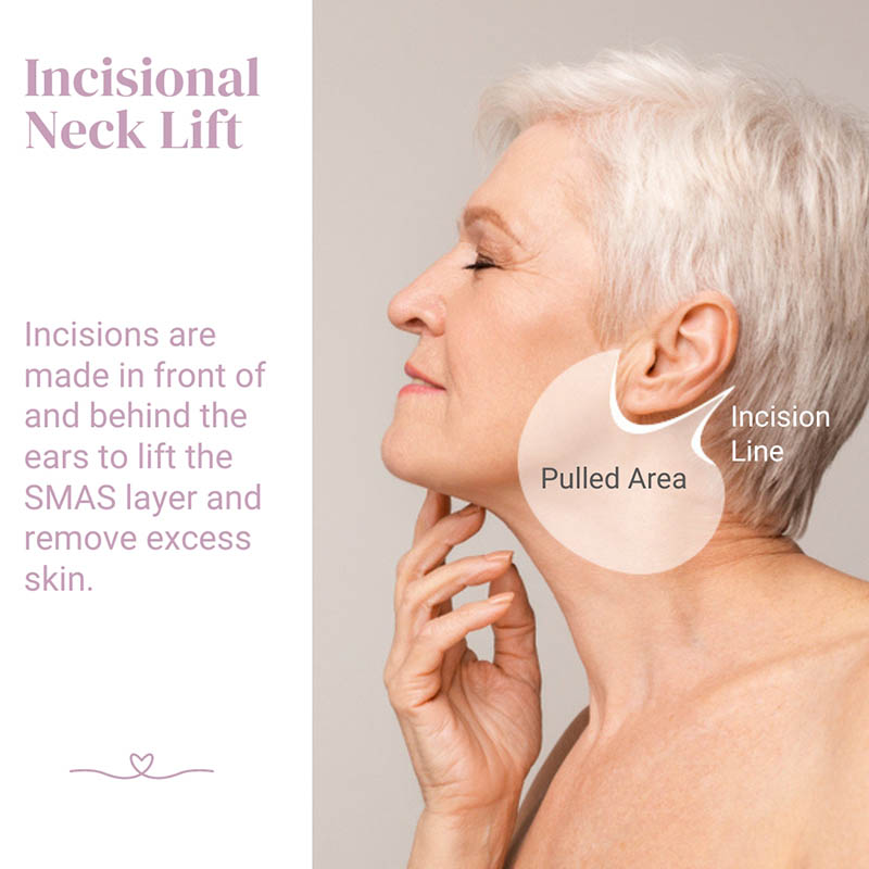 Incisional Neck Lift